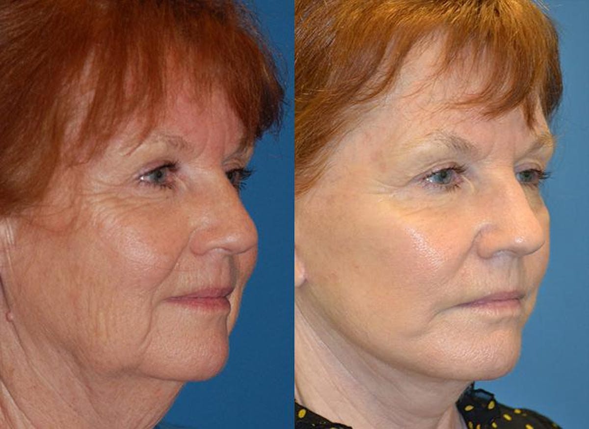Facelift Before & After Gallery - Patient 122405923 - Image 2