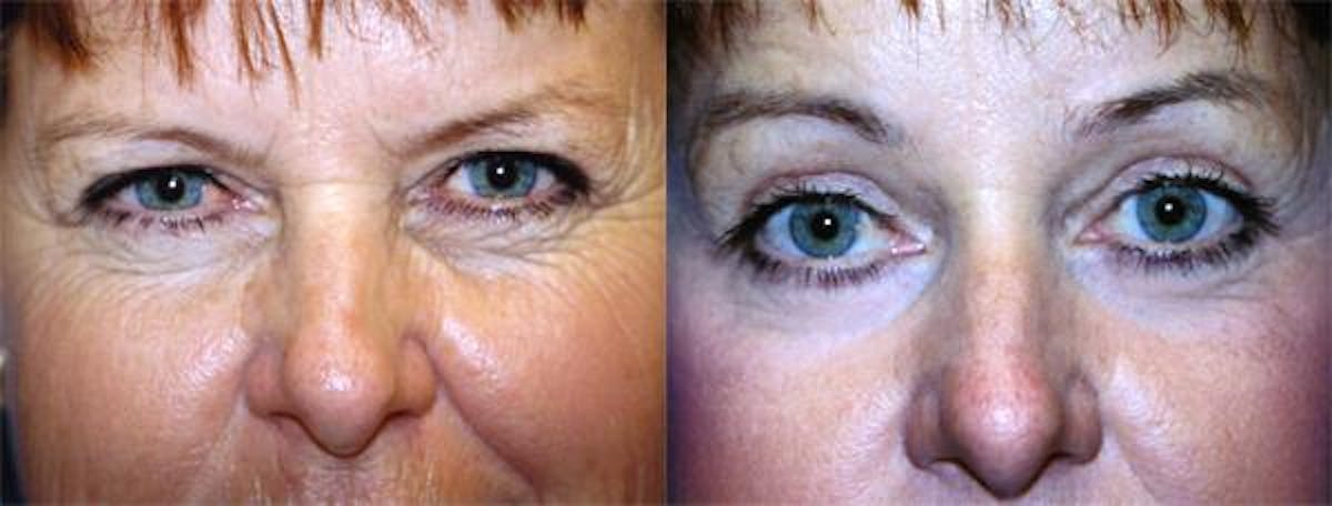 Eyelid Surgery Before & After Gallery - Patient 122405922 - Image 1