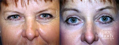 Eyelid Surgery Before & After Gallery - Patient 387702 - Image 1