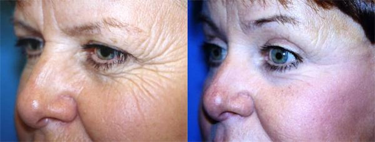 Eyelid Surgery Before & After Gallery - Patient 122405922 - Image 2