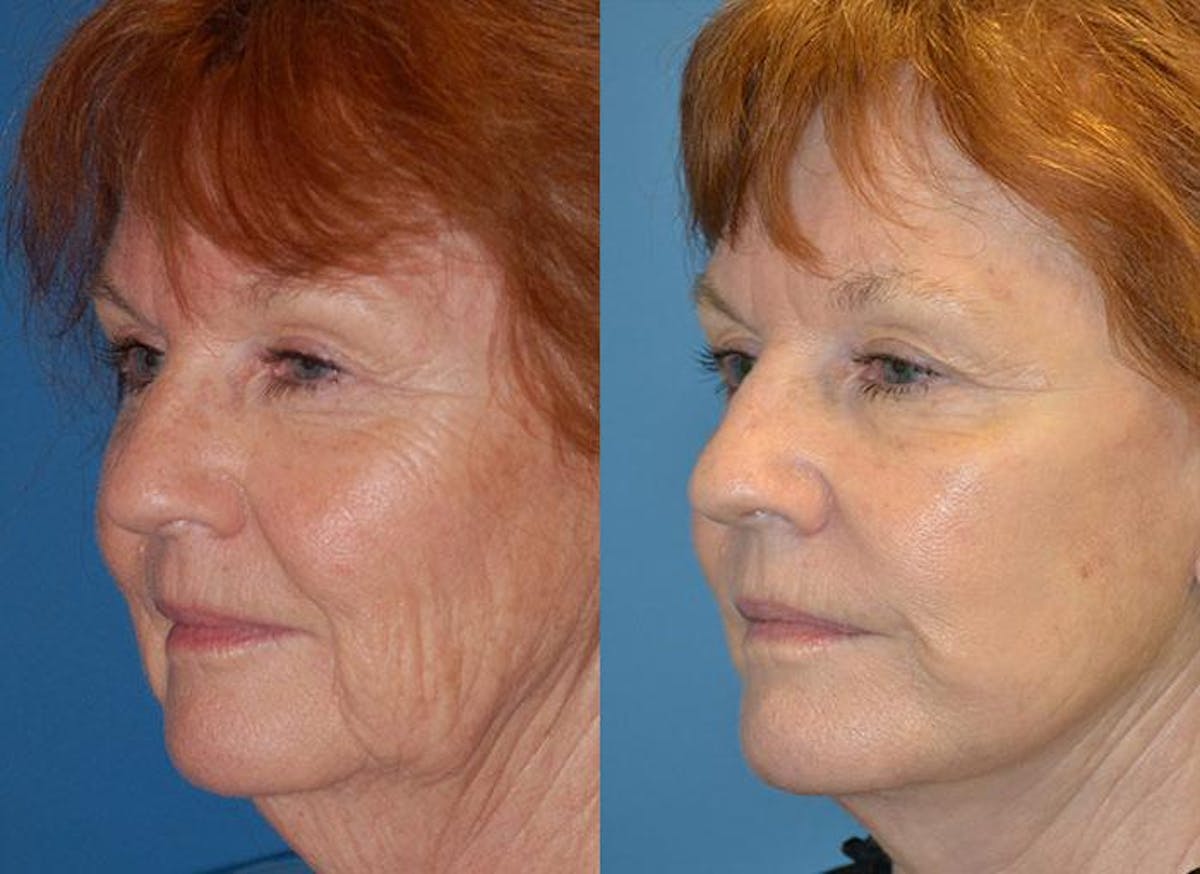 Facelift Before & After Gallery - Patient 122405923 - Image 3
