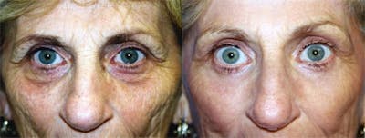 Eyelid Surgery Before & After Gallery - Patient 122405924 - Image 1