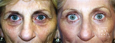 Eyelid Surgery Before & After Gallery - Patient 244504 - Image 1