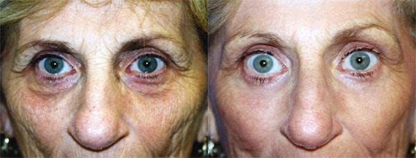 Eyelid Surgery Gallery - Patient 122405924 - Image 1
