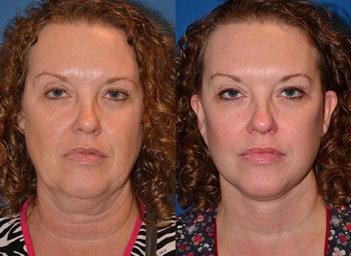 Facelift Before & After Gallery - Patient 122405925 - Image 1