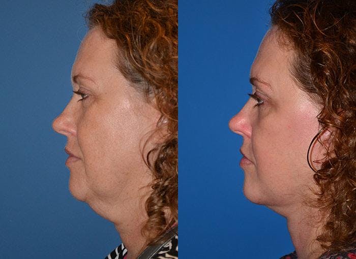 Facelift Before & After Gallery - Patient 122405925 - Image 2