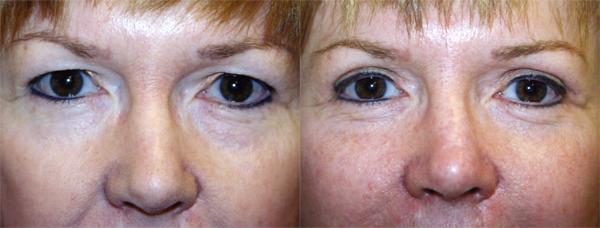 Eyelid Surgery Before & After Gallery - Patient 237428 - Image 1