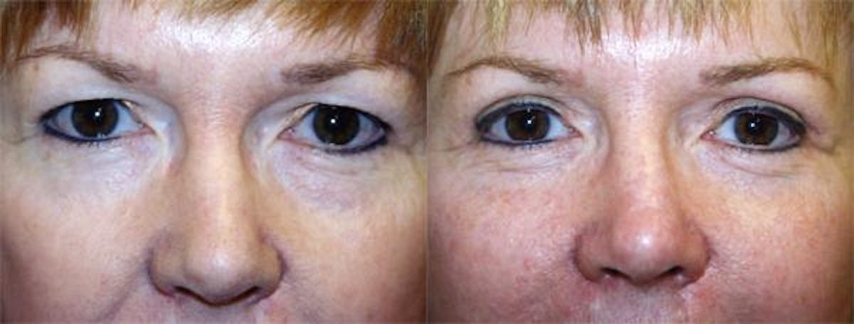 Eyelid Surgery Before & After Gallery - Patient 122405926 - Image 1