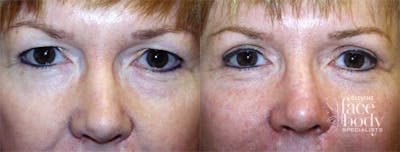 Eyelid Surgery Before & After Gallery - Patient 237428 - Image 1