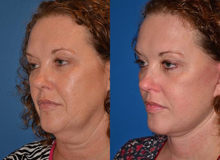 Facelift Before & After Gallery - Patient 122405925 - Image 3