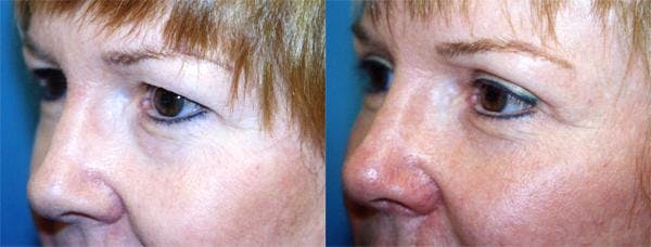Eyelid Surgery Before & After Gallery - Patient 122405926 - Image 2