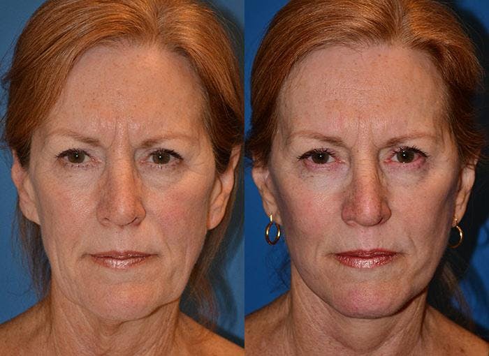Facelift Before & After Gallery - Patient 122405928 - Image 1