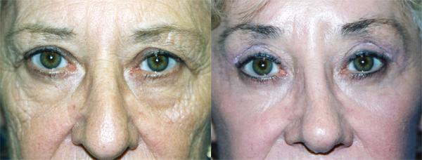 Eyelid Surgery Before & After Gallery - Patient 161114 - Image 1
