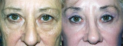 Eyelid Surgery Before & After Gallery - Patient 122405927 - Image 1