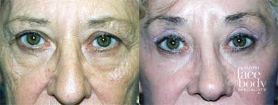 Eyelid Surgery Before & After Gallery - Patient 161114 - Image 1