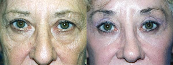 Eyelid Surgery Before & After Gallery - Patient 122405927 - Image 1