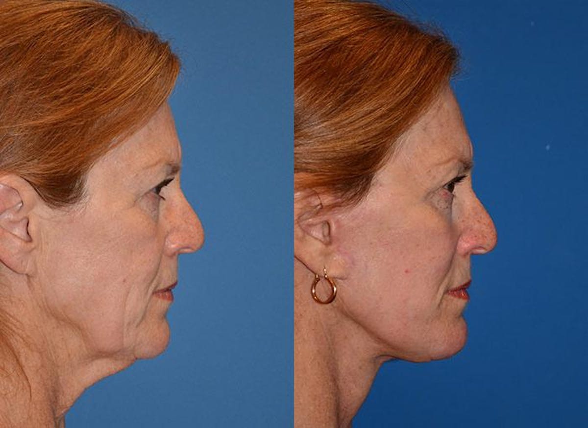 Facelift Before & After Gallery - Patient 122405928 - Image 2