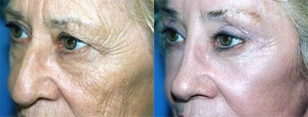 Eyelid Surgery Before & After Gallery - Patient 122405927 - Image 2