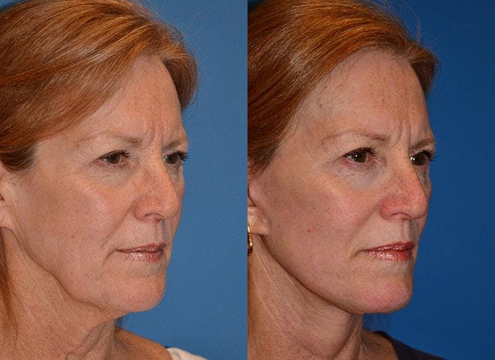 Facelift Before & After Gallery - Patient 122405928 - Image 3