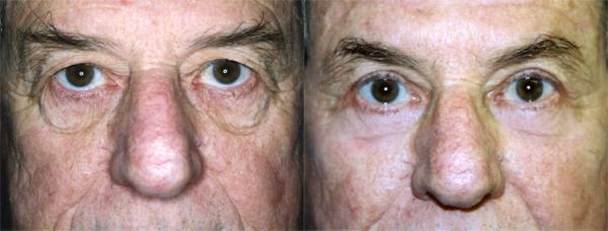 Eyelid Surgery Before & After Gallery - Patient 122405929 - Image 1