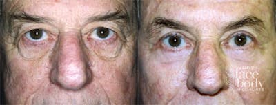 Eyelid Surgery Before & After Gallery - Patient 134345 - Image 1