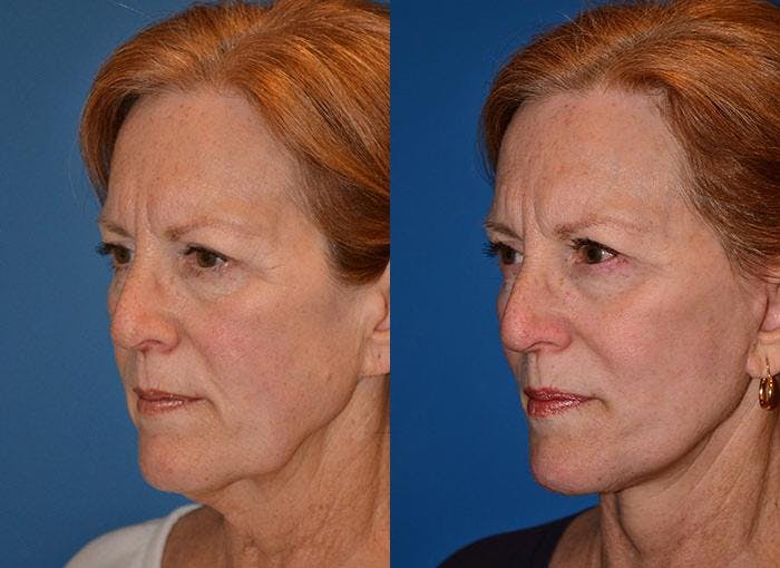 Facelift Before & After Gallery - Patient 122405928 - Image 4