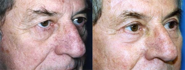 Eyelid Surgery Gallery - Patient 122405929 - Image 2