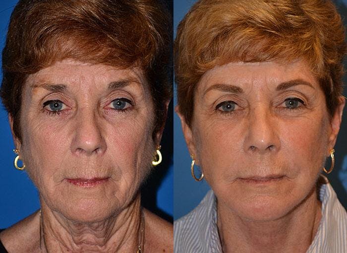 Facelift Before & After Gallery - Patient 122405931 - Image 1