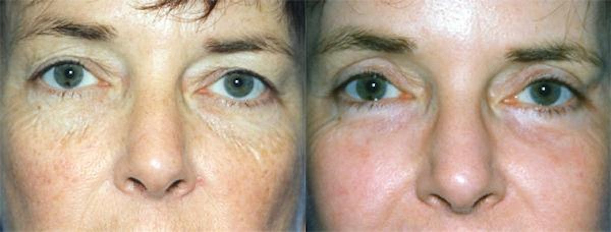 Eyelid Surgery Before & After Gallery - Patient 122405930 - Image 1