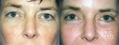 Eyelid Surgery Before & After Gallery - Patient 114053 - Image 1