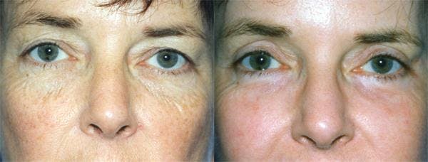 Eyelid Surgery Before & After Gallery - Patient 122405930 - Image 1