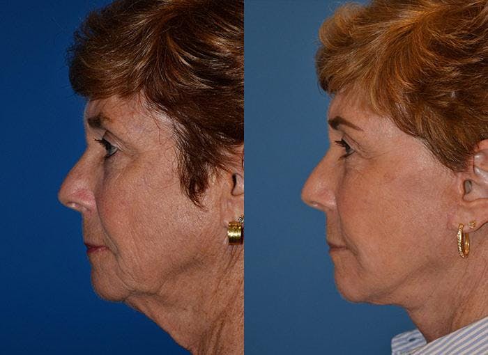 Facelift Before & After Gallery - Patient 122405931 - Image 2