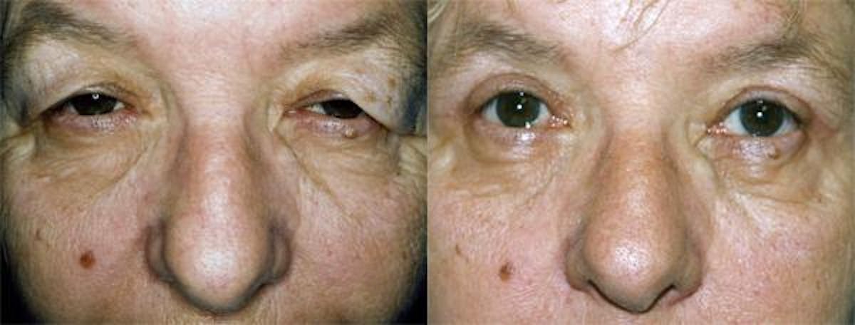 Eyelid Surgery Before & After Gallery - Patient 122405932 - Image 1