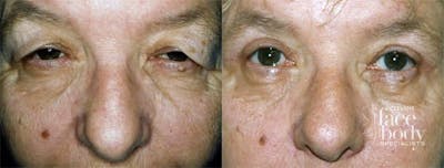 Eyelid Surgery Before & After Gallery - Patient 551816 - Image 1