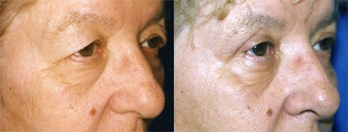 Eyelid Surgery Before & After Gallery - Patient 122405932 - Image 2