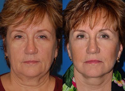 Facelift Before & After Gallery - Patient 122405934 - Image 1