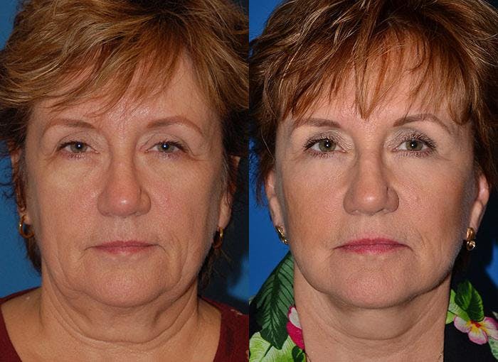 Facelift Before & After Gallery - Patient 122405934 - Image 1