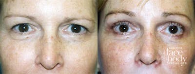 Eyelid Surgery Before & After Gallery - Patient 371675 - Image 1