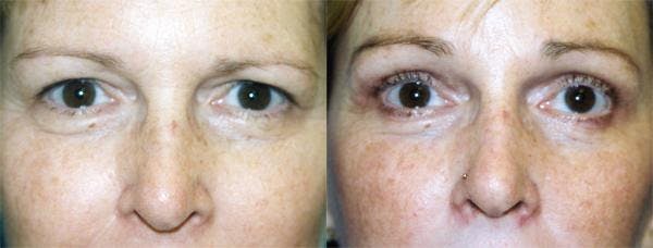 Eyelid Surgery Before & After Gallery - Patient 122405933 - Image 1