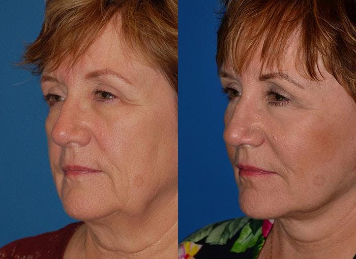 Facelift Before & After Gallery - Patient 122405934 - Image 2