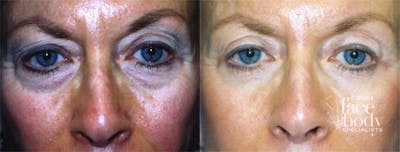 Eyelid Surgery Before & After Gallery - Patient 270993 - Image 1
