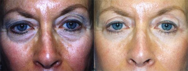 Eyelid Surgery Before & After Gallery - Patient 122405935 - Image 1
