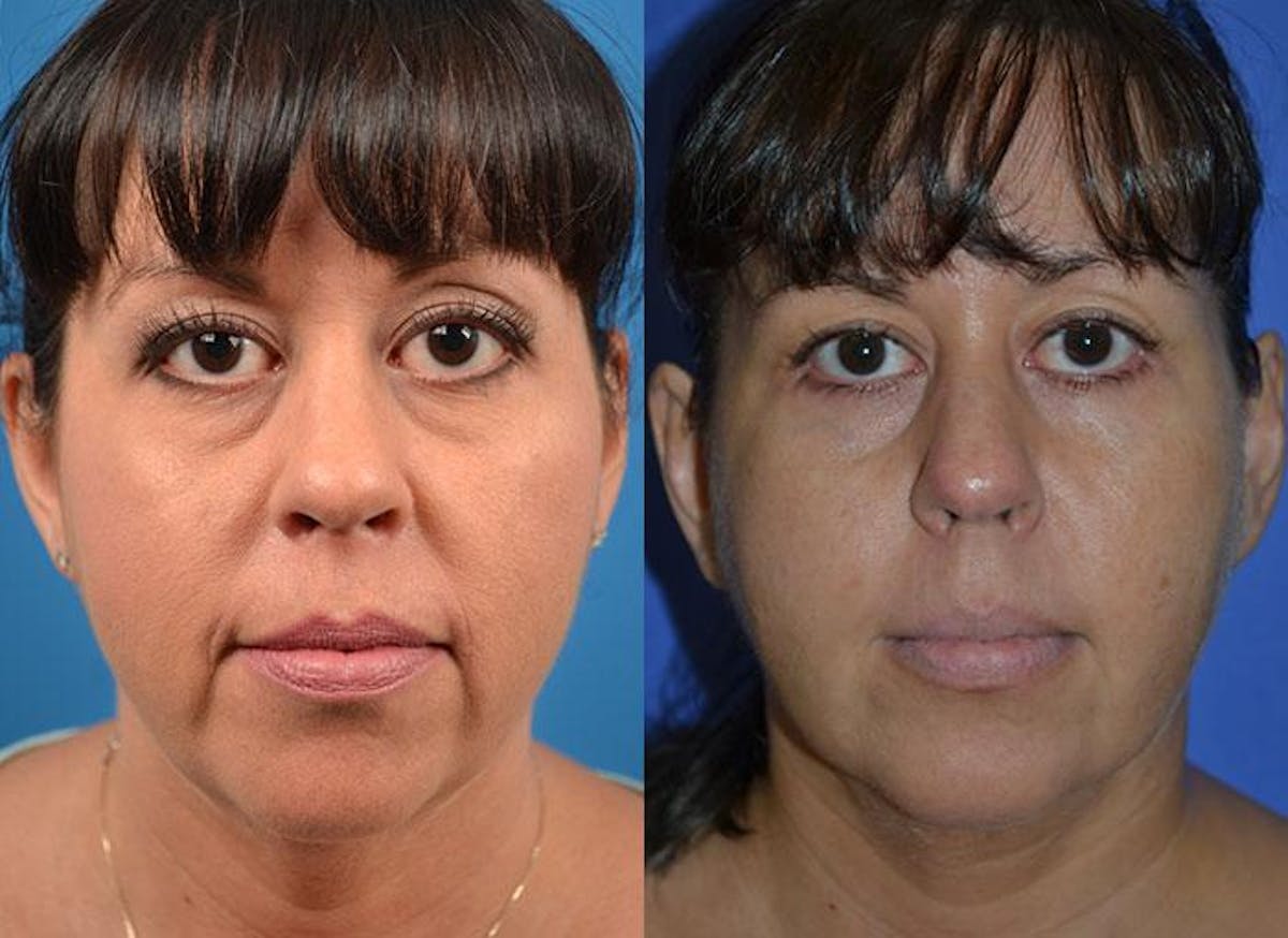 Facelift Before & After Gallery - Patient 122405936 - Image 1