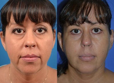 Facelift Before & After Gallery - Patient 122405936 - Image 1