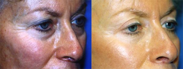 Eyelid Surgery Before & After Gallery - Patient 270993 - Image 2