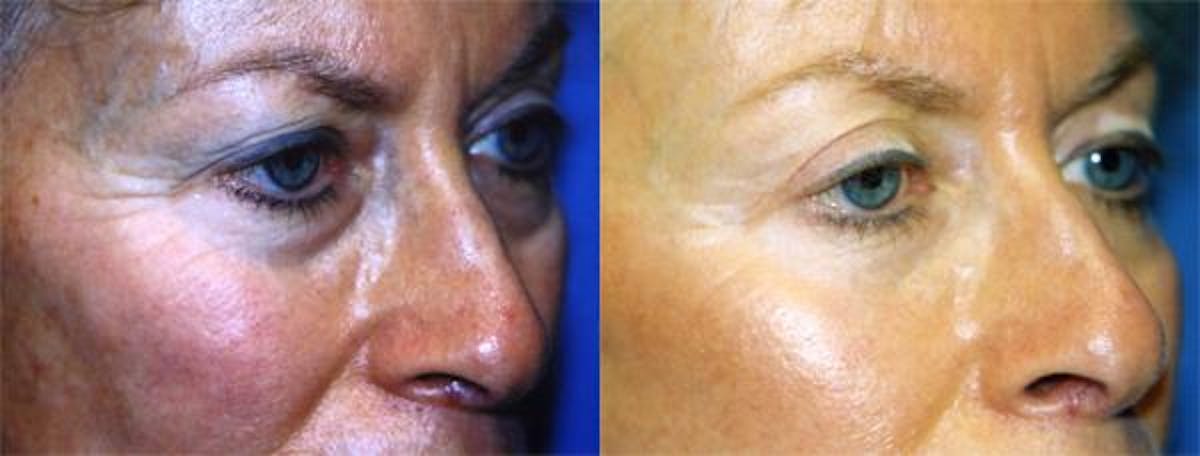 Eyelid Surgery Before & After Gallery - Patient 122405935 - Image 2