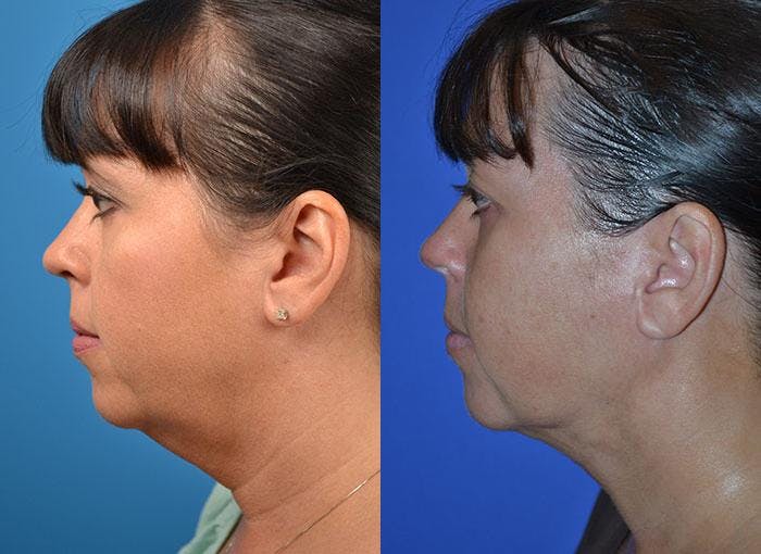 Facelift Before & After Gallery - Patient 122405936 - Image 2