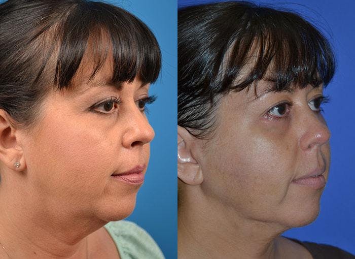 Facelift Before & After Gallery - Patient 122405936 - Image 3