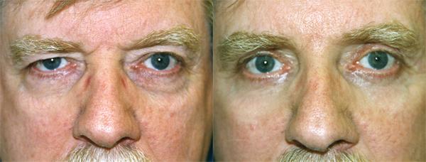 Eyelid Surgery Before & After Gallery - Patient 125434 - Image 1