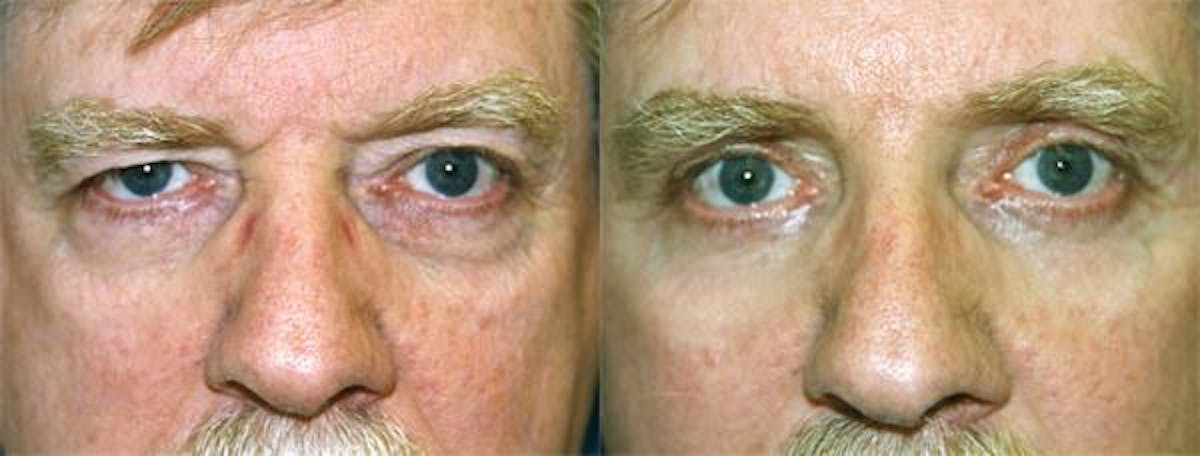 Eyelid Surgery Before & After Gallery - Patient 122405938 - Image 1